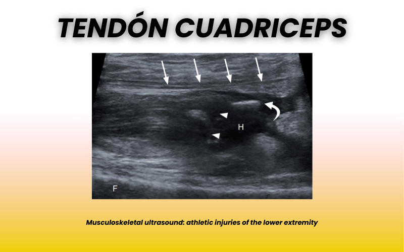 4. Tendon cuadricipital patologia rodilla.png